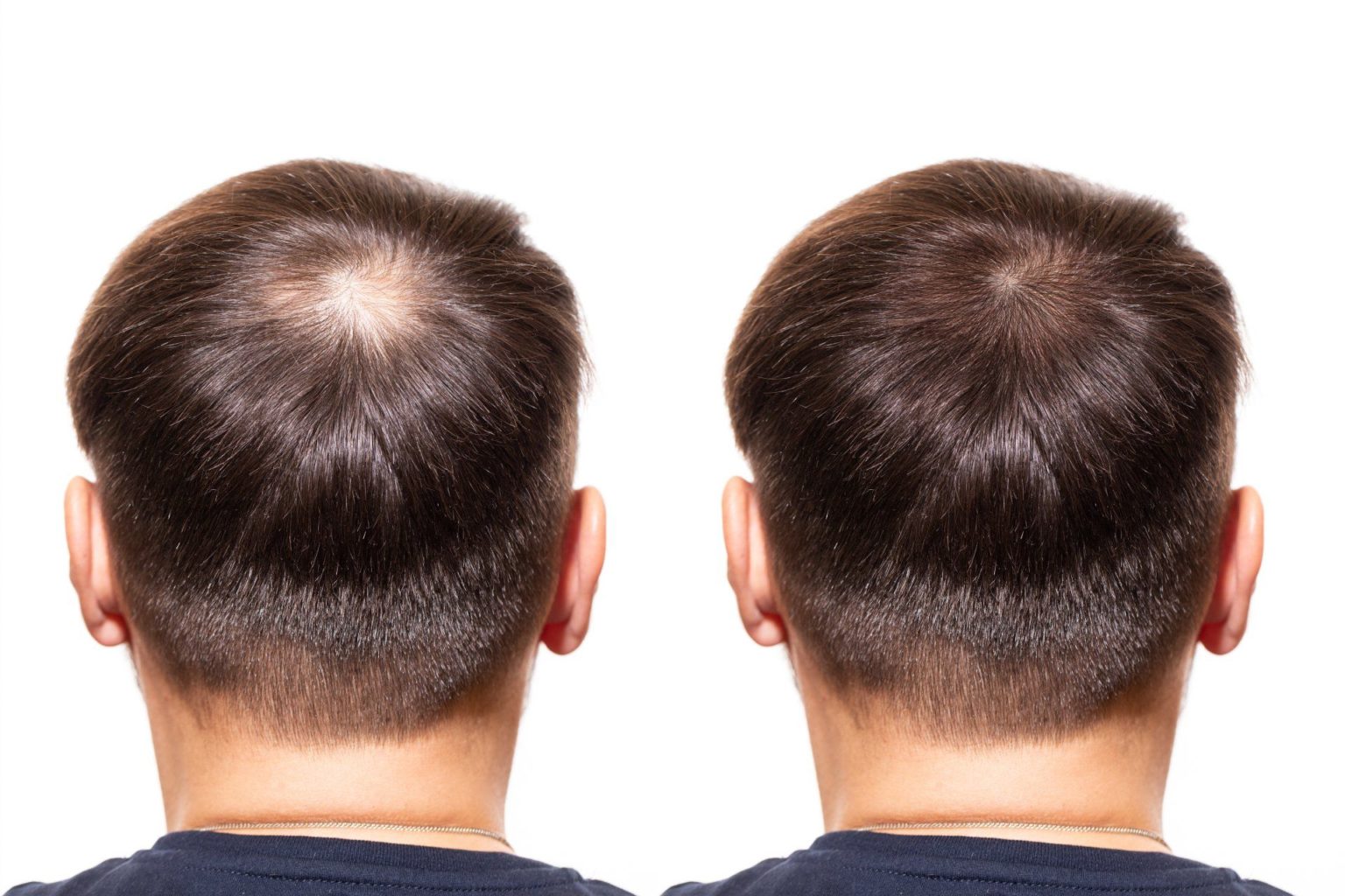 Как определить облысение или выпадение волос